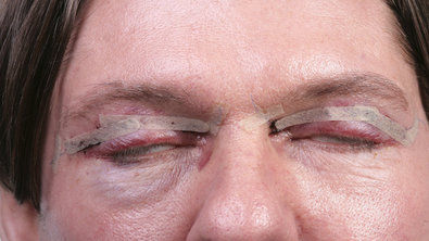 zwelling na ooglidcorrectie