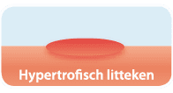 Soorten littekens: hypertrofisch 