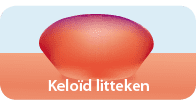 Soorten littekens: Keloïd