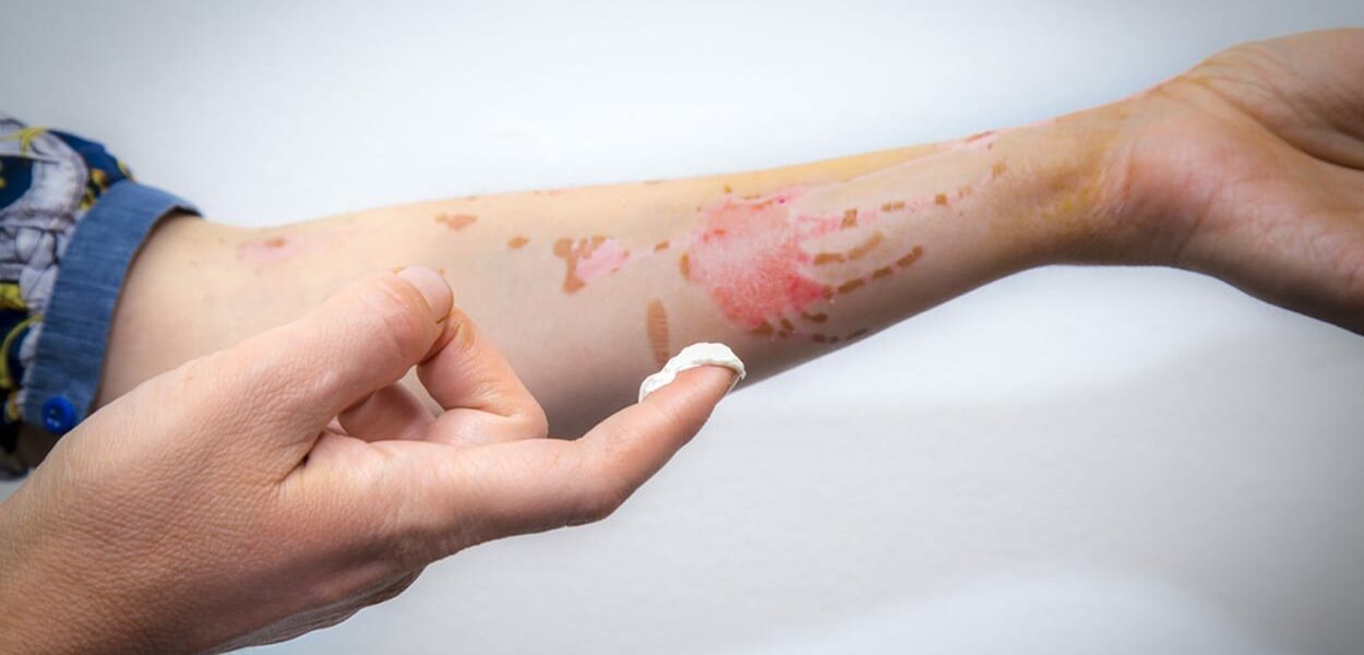 Littekencrème tegen uitdroging van je litteken