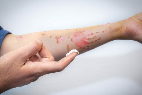 Littekencrème tegen uitdroging van je litteken