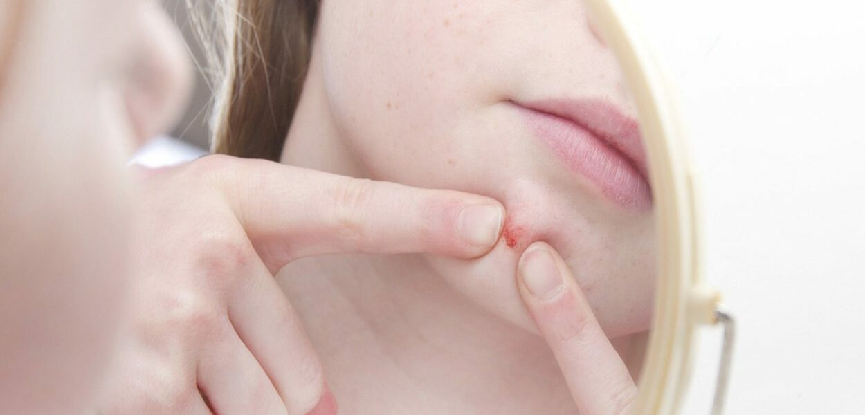 acne littekens voorkomen en verminderen