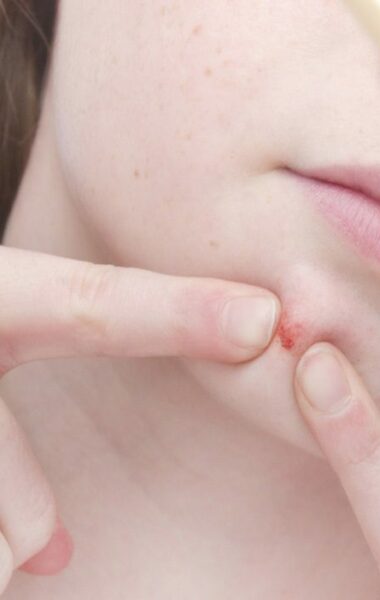 acne littekens voorkomen en verminderen