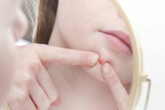 acne littekens voorkomen en verminderen