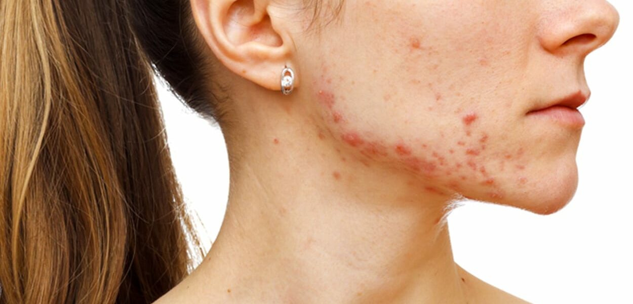 Acne littekens