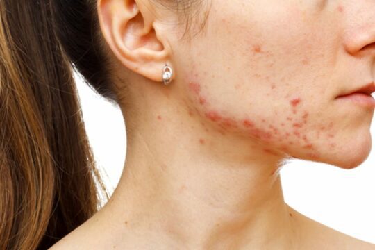 Acne littekens