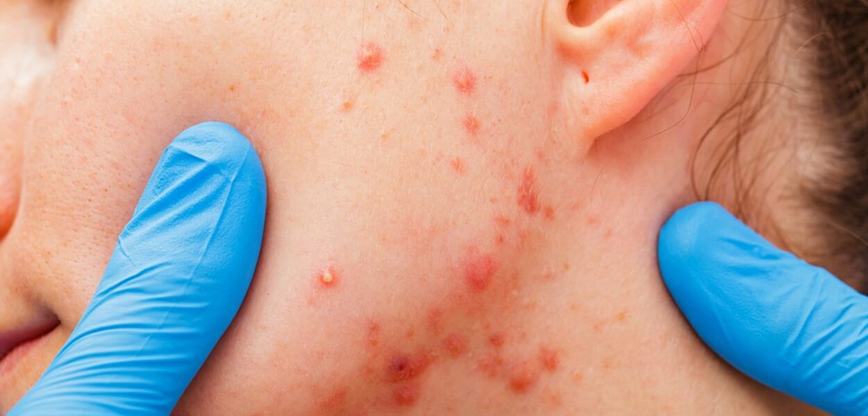 Acne littekens voorkomen