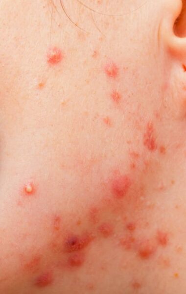 Acne littekens voorkomen