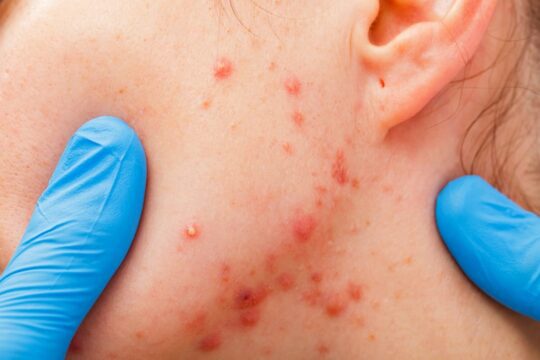 Acne littekens voorkomen