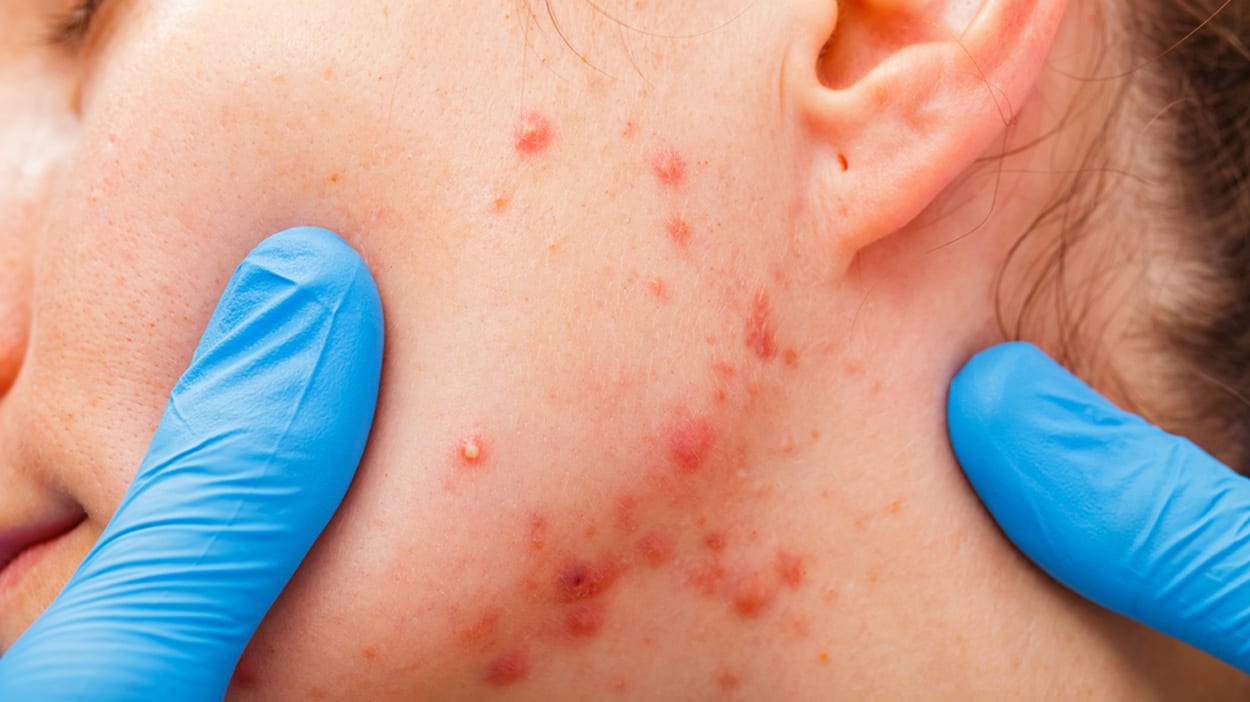 Hoe kun acne littekens voorkomen? | ALHYDRAN