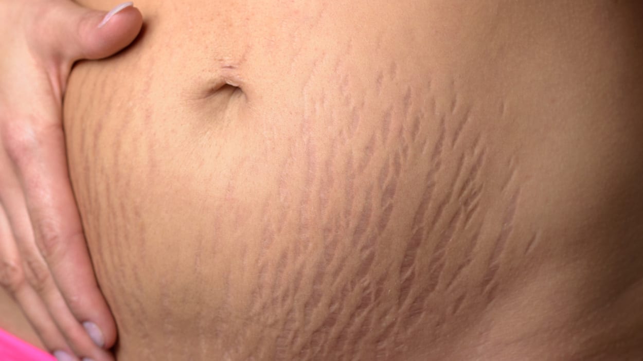 Kun Je Striae Verminderen Voorkomen Of Verwijderen Met Creme