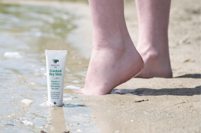 Cracked dry skin care 5