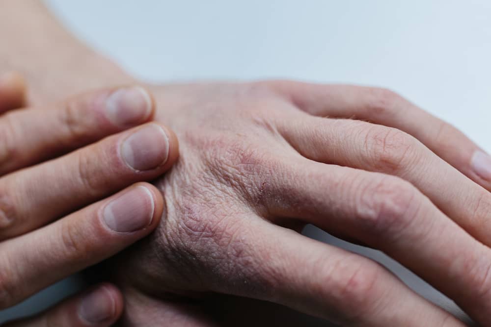 Handcrème droge huid op je handen | ALHYDRAN