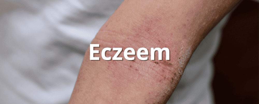 Eczeem