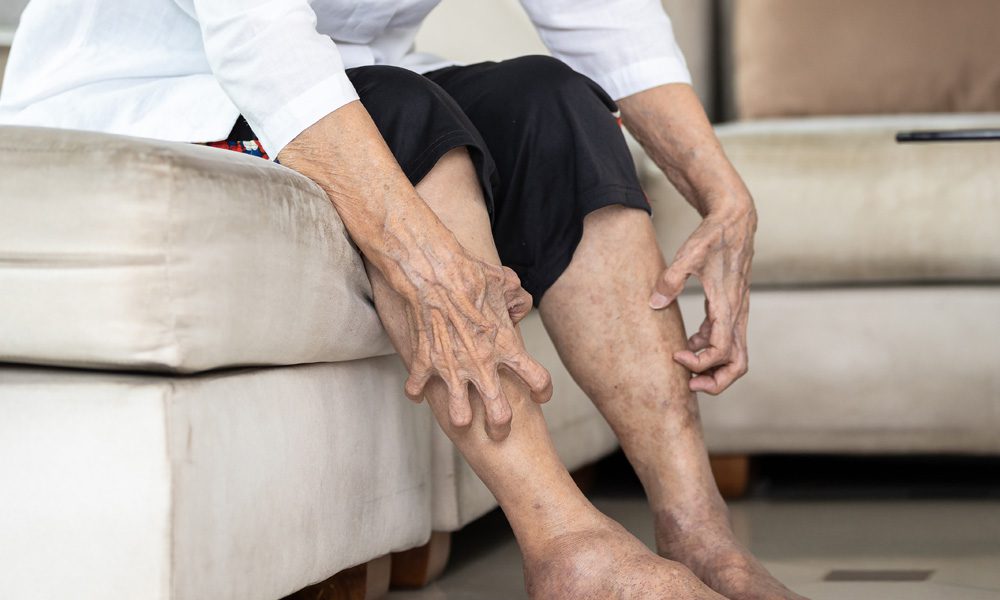 Iemand krabt aan zijn benen, jeuk neemt toe.