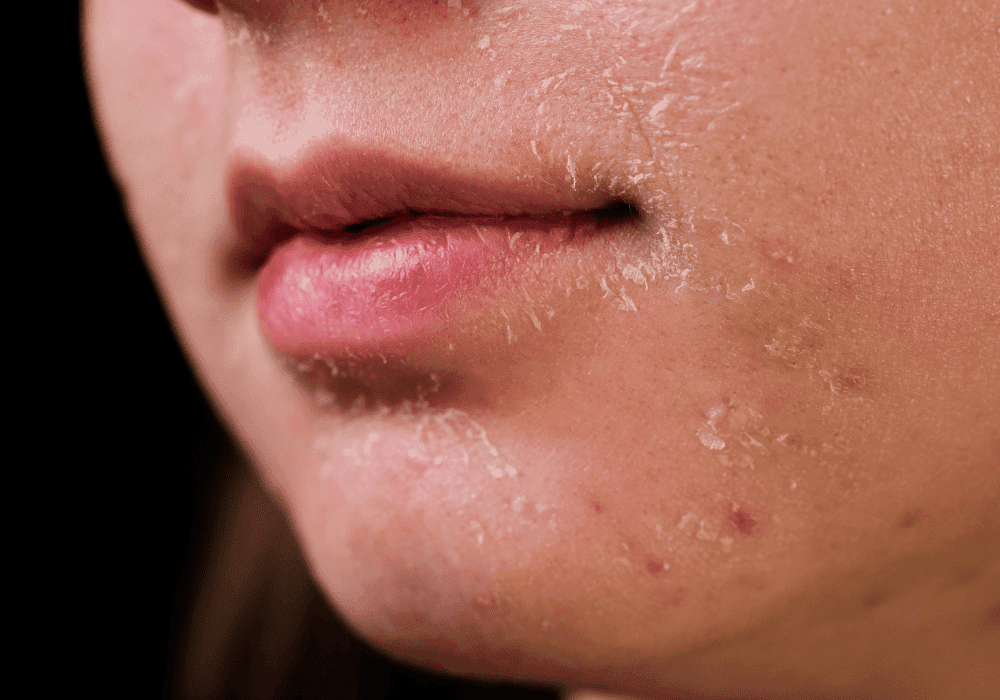 Allergische reactie na een chemische peeling? ALHYDRAN