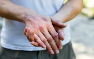 Contacteczeem-hand