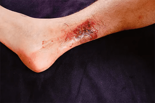 derde graads brandwond