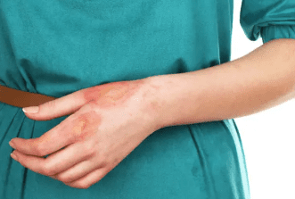 eerste graads brandwond