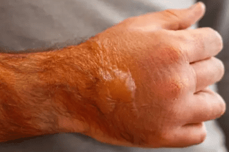 Tweede graads brandwond