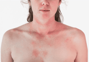 huiduitslag gezicht hals decolleté